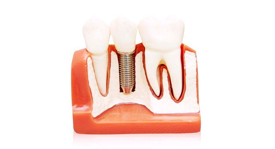 Il modello di un impianto dentale con la corona