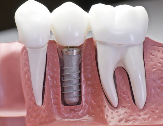 Il modello di un impianto dentale tra due denti
